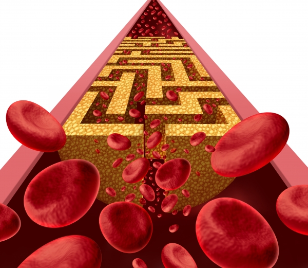 콜레스테롤 정상수치