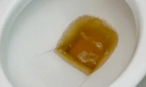 신장이 안좋으면 나타나는 증상 20