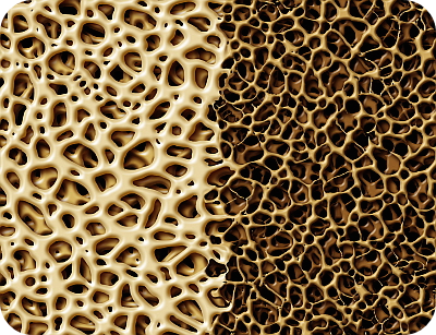 마그네슘-부족현상-골다공증