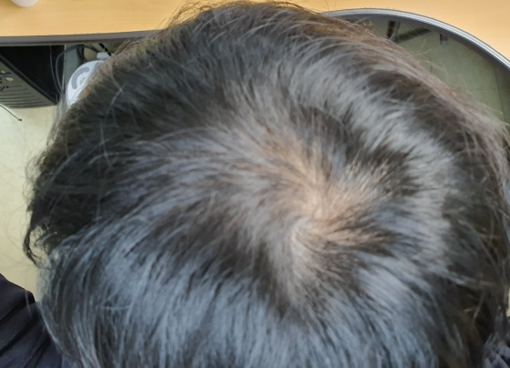 정수리-탈모시작-모습