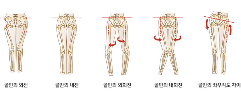 골반 비대칭1