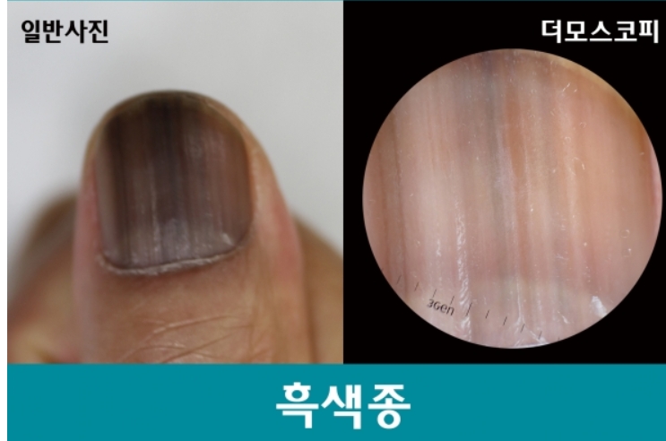 손톱 흑색종 출처 서울대병원