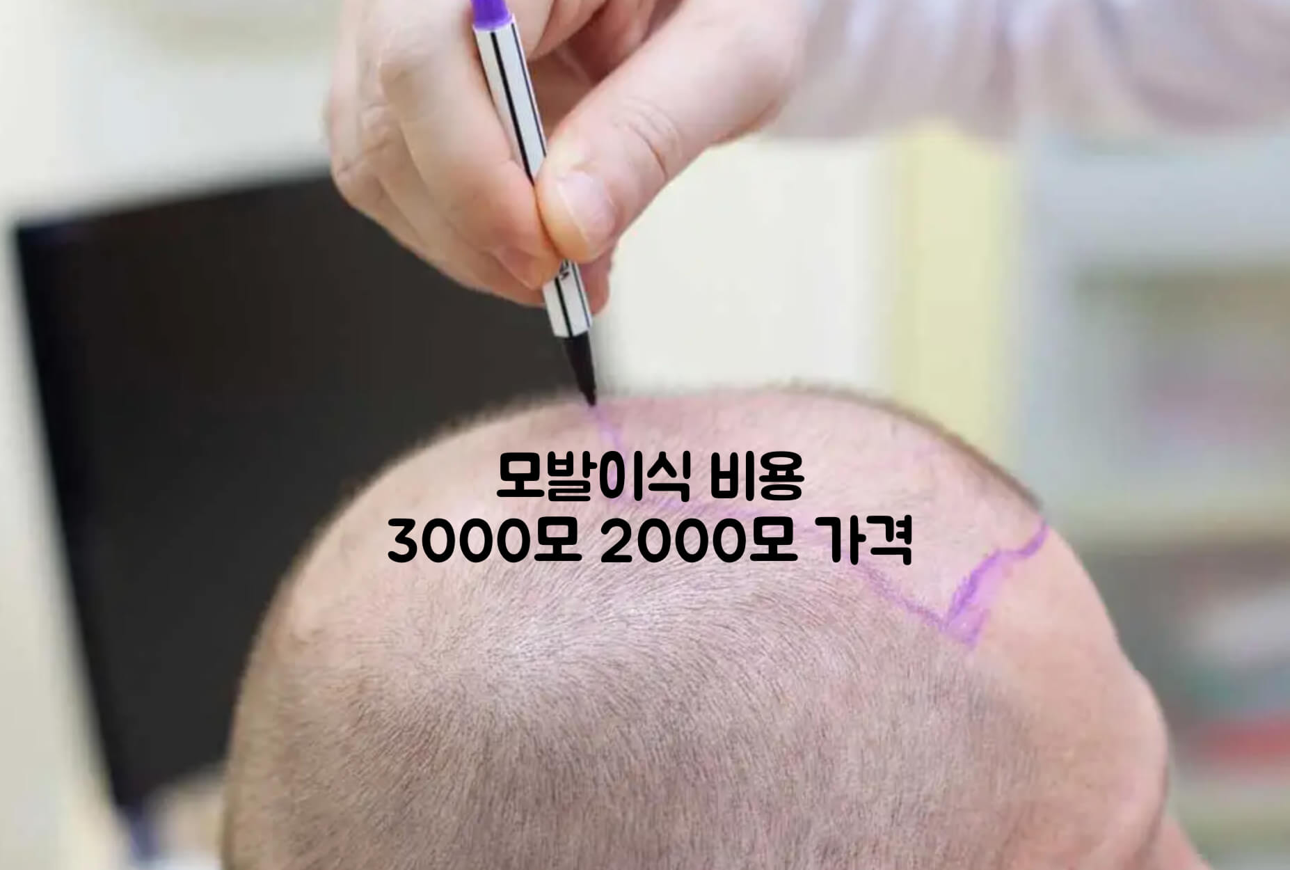 모발이식 비용