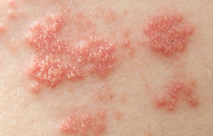 대상포진초기증상-사진