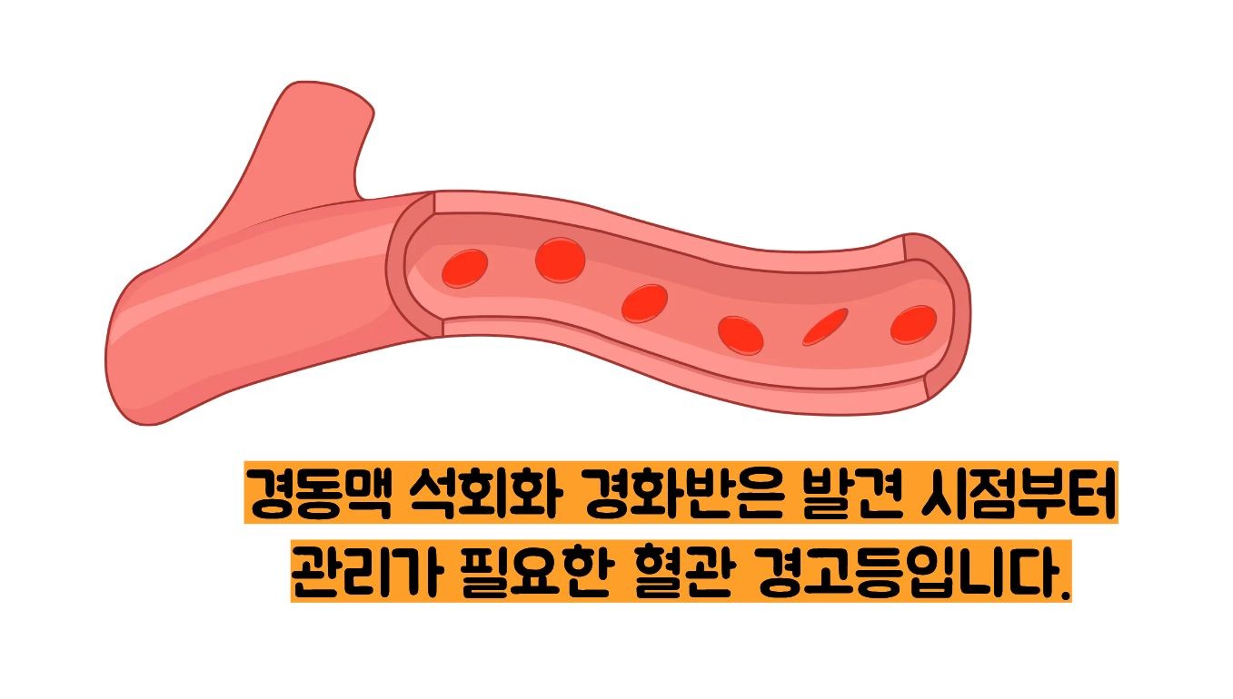 경동맥 석회화 경화반