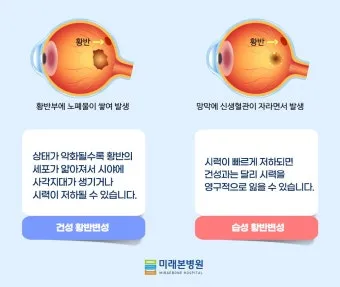 시야에 검은점 시야에 까만점이 보일때 원인과 대처법_12