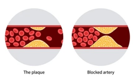  혈압이 높아지는 이유 