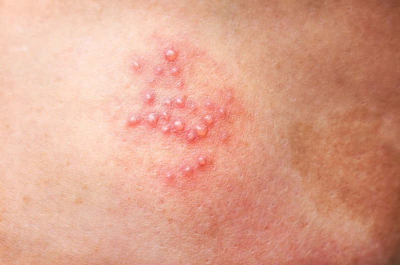 대상포진 원인 (면역, 바이러스, 신경)