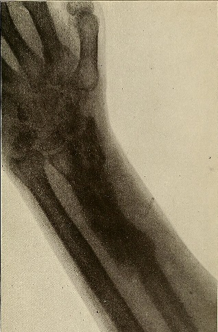 골절-뼈에금갔을때