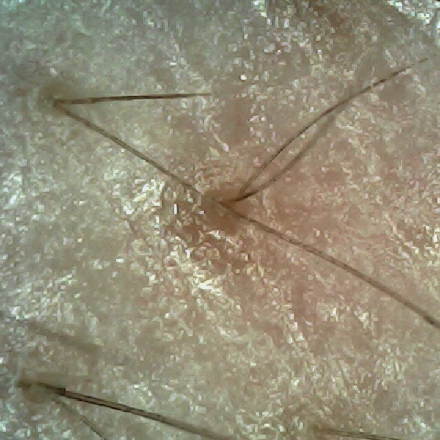 탈모 극복 프로젝트 - 오른쪽 M자 부위 두피 모습이다.