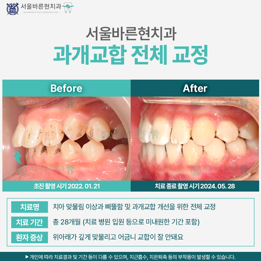 부산과개교합 교정