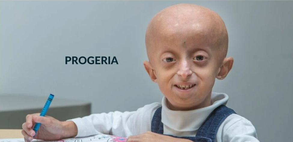 조로증을 않고 있는 아이