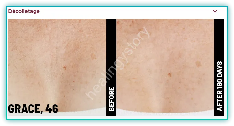 데콜테전후사진