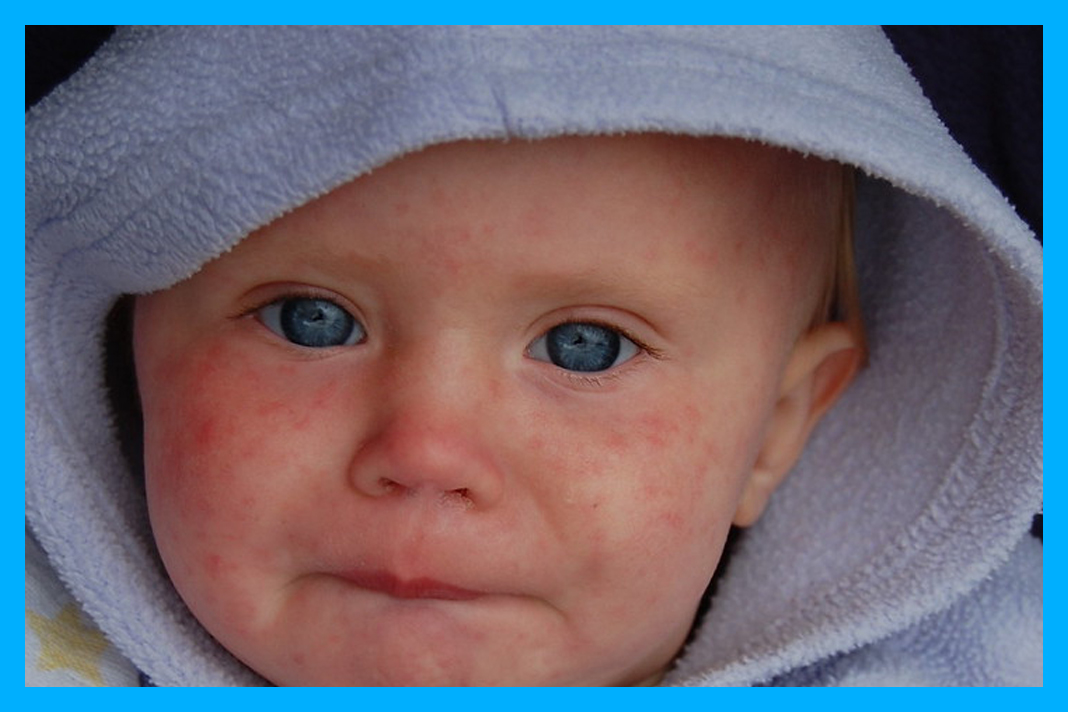 홍역_증상