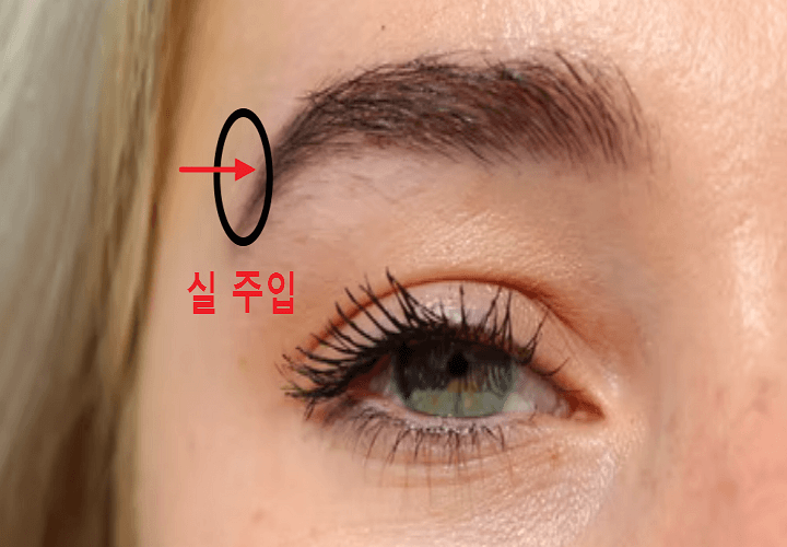 실리프팅-실을-주입하는-위치