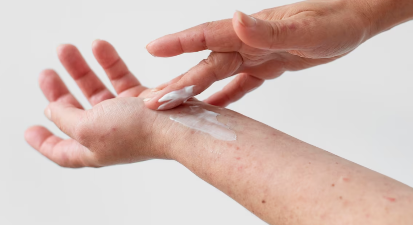 땀띠의 치료방법