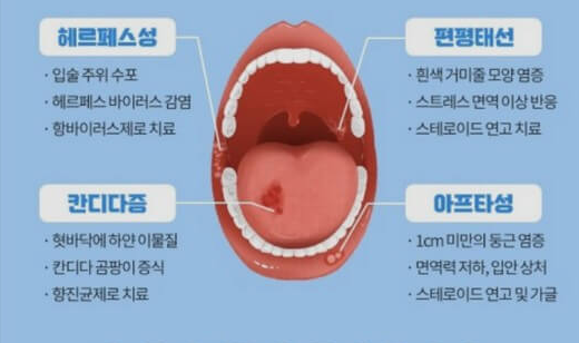 구내염-전염성