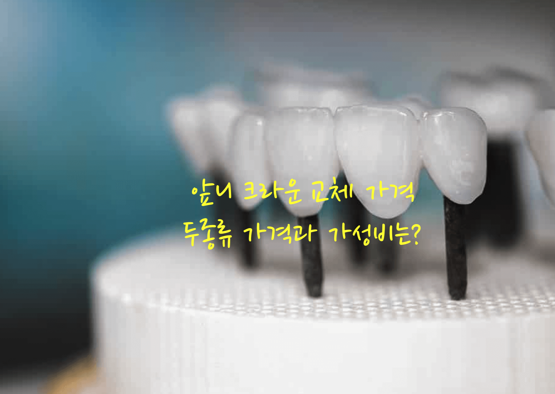 앞니 크라운 교체