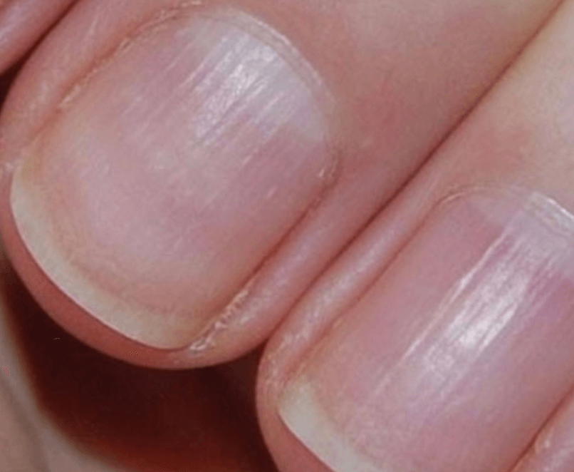 손톱에 세로줄이 생기는 이유