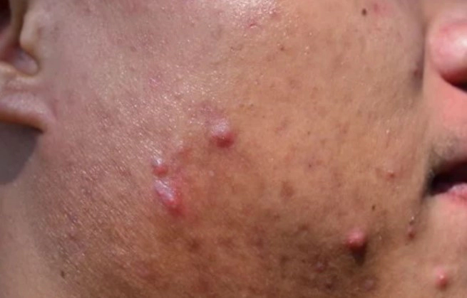 화농성 여드름 자주 묻는 질문(FAQ)