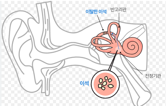 이석증 증상과 자가치료법