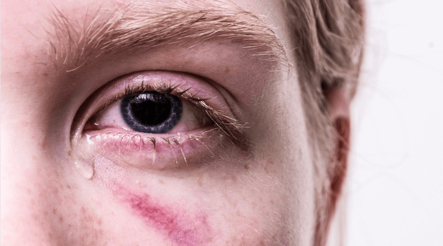 눈이 아픈 이유로 눈물을 흘리고 있는 사람