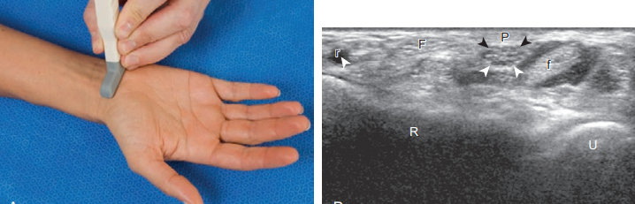 손목: 손바닥쪽 검사