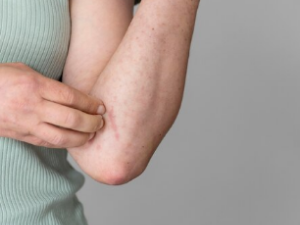 대상포진 치료 방법/좋은 음식