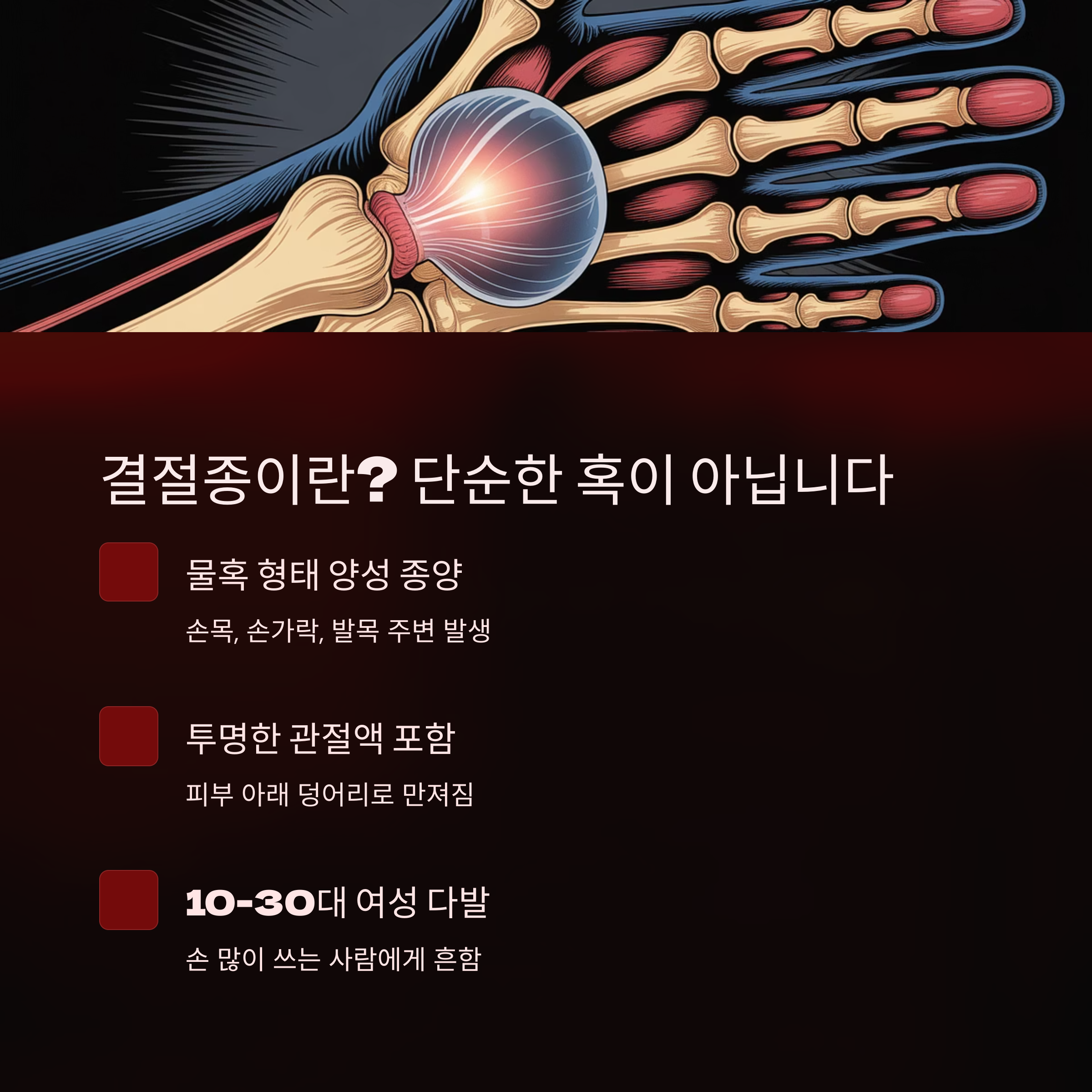 결절종의 특징과 발생 위치를 설명한 인포그래픽, 손 뼈 구조와 붉은 관절 부위 강조