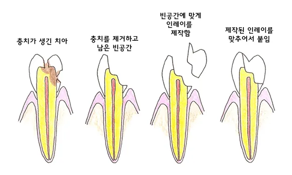 인레이 온레이의 차이와 치료 방법_8