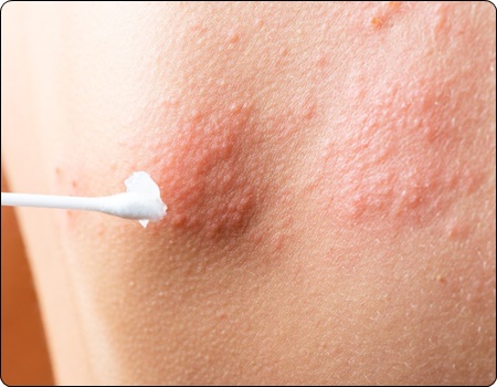 대상포진 예방접종 가격