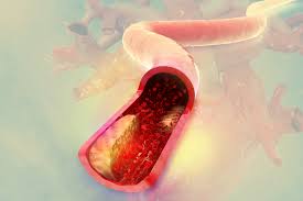 콜레스테롤 낮추는 방법 10가지