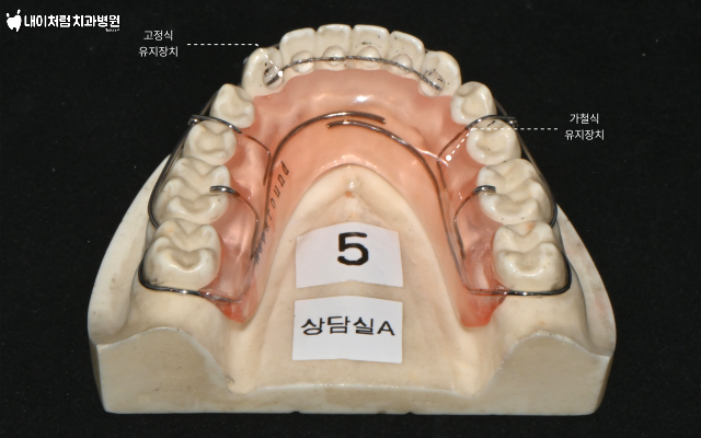 이수역치과 교정 유지장치 떨어짐 끊어짐 (고정식 유지장치, 가철식 유지장치)