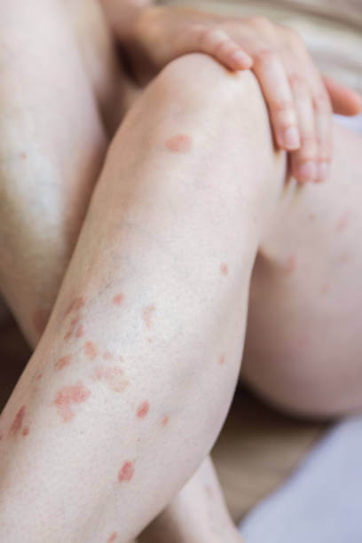 대상포진 예방접종 가격