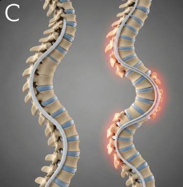 척추 측만증 검사 방법과 병원 선택3