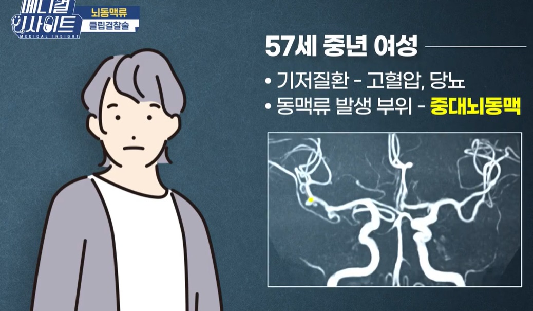 뇌동맥류-윤원기-의사