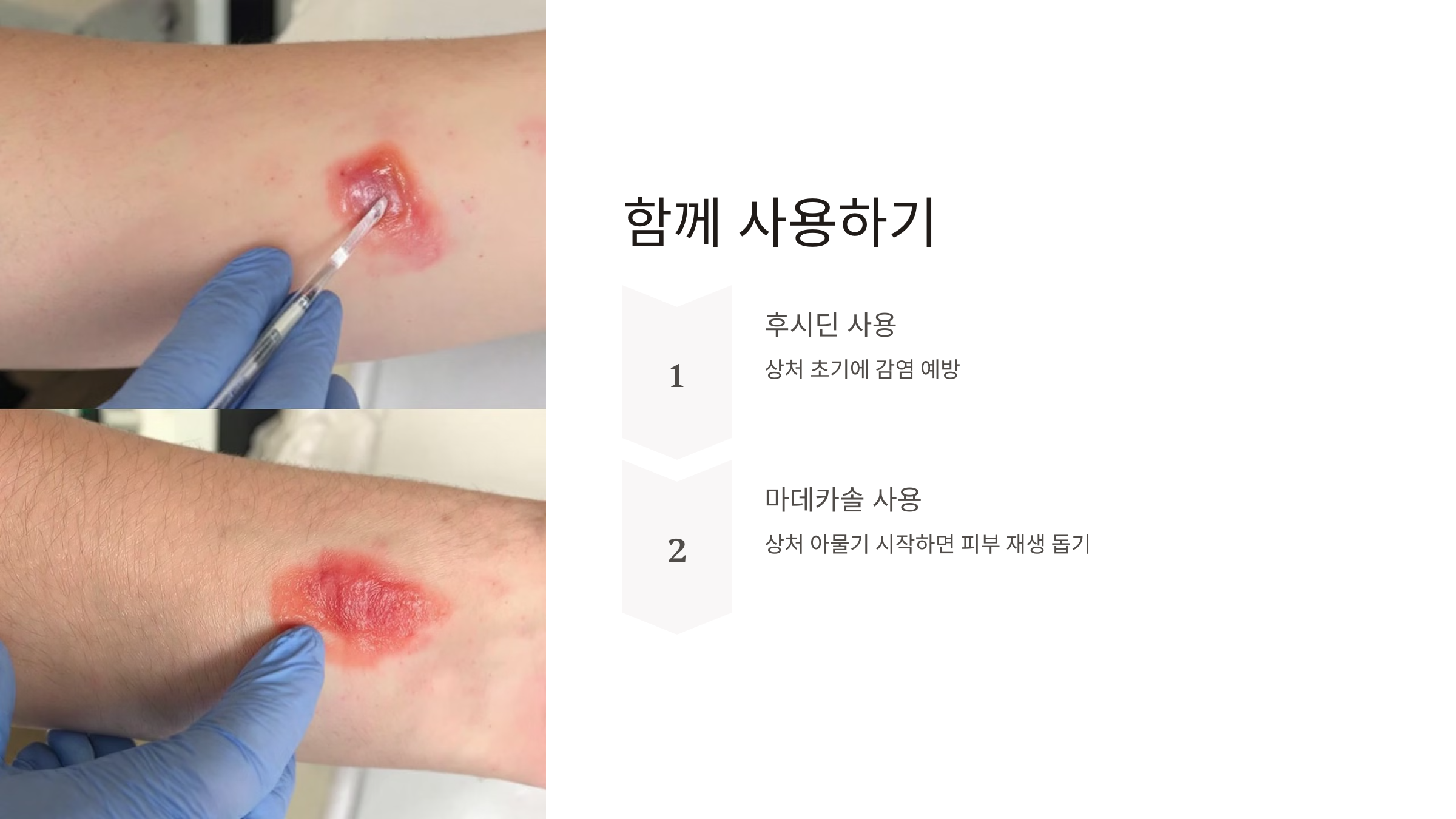 마데카솔 후시딘 차이 효능 효과 가격