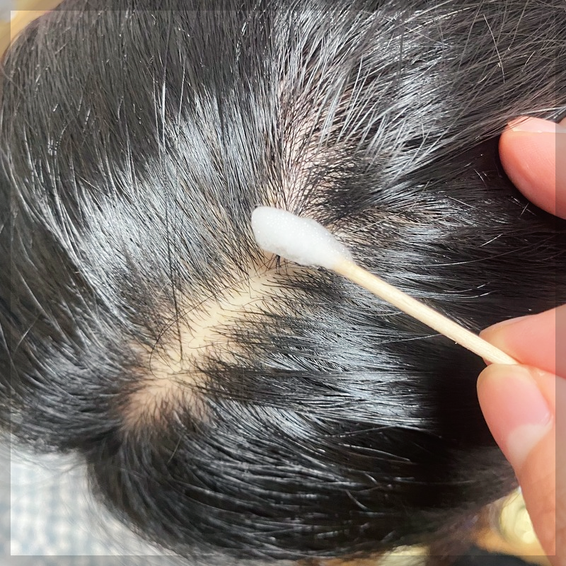 로게인폼-가격-로게인폼-부작용