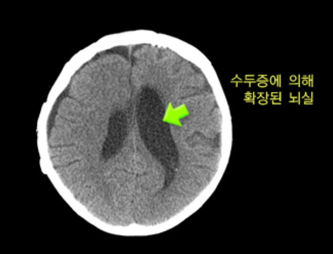 치매란? 치매와 유사한 증상의 병들