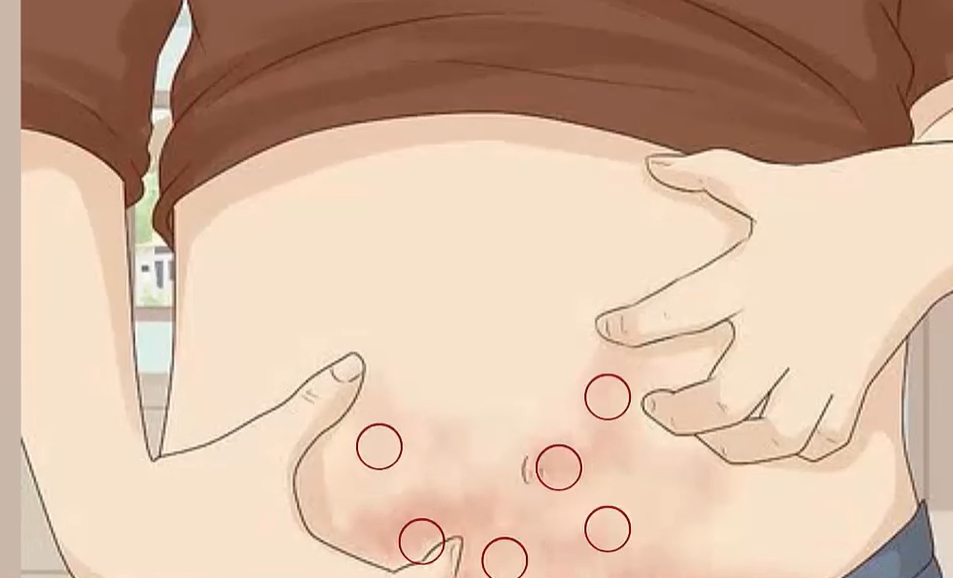 사타구니 가려움증