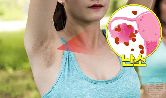 겨드랑이 까만색 착색 원인 다낭성난소증후군 겨드랑이 까만 이유