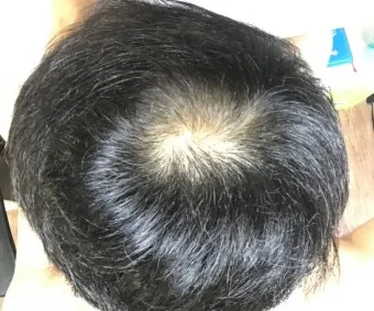 정수리가 아픈 이유와 완화하는 방법_10