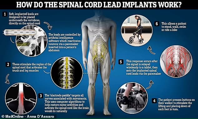 하반신 마비 환자를 위한 혁신적인 척수 임플란트 VIDEO: Surgeons insert spinal cord implant to activate paraplegic's