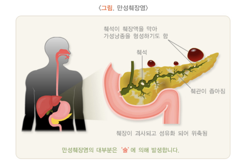 만성췌장염