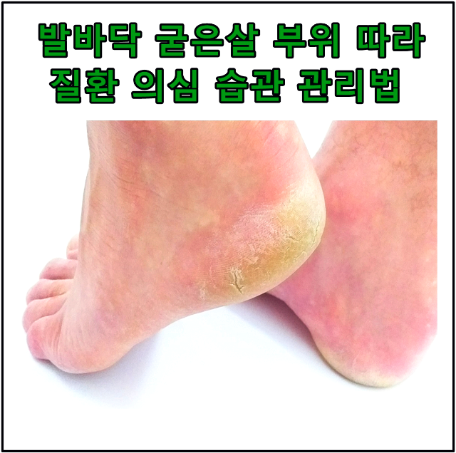 발바닥 굳은살 부위 따라 질환 의심 습관 관리법