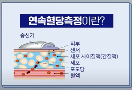 연속혈당측정기