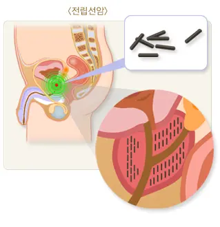 전립선암-구조-이미지