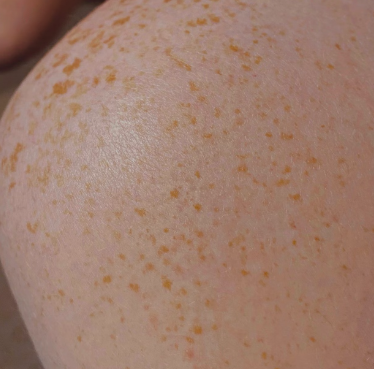 아르기닌 효능 - 피부 회복