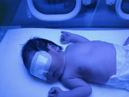 신생아 황달: 원인과 치료 방법