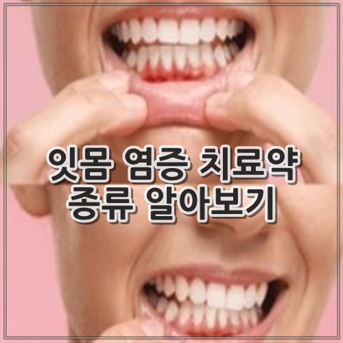 잇몸 염증 치료약 종류 알아보기